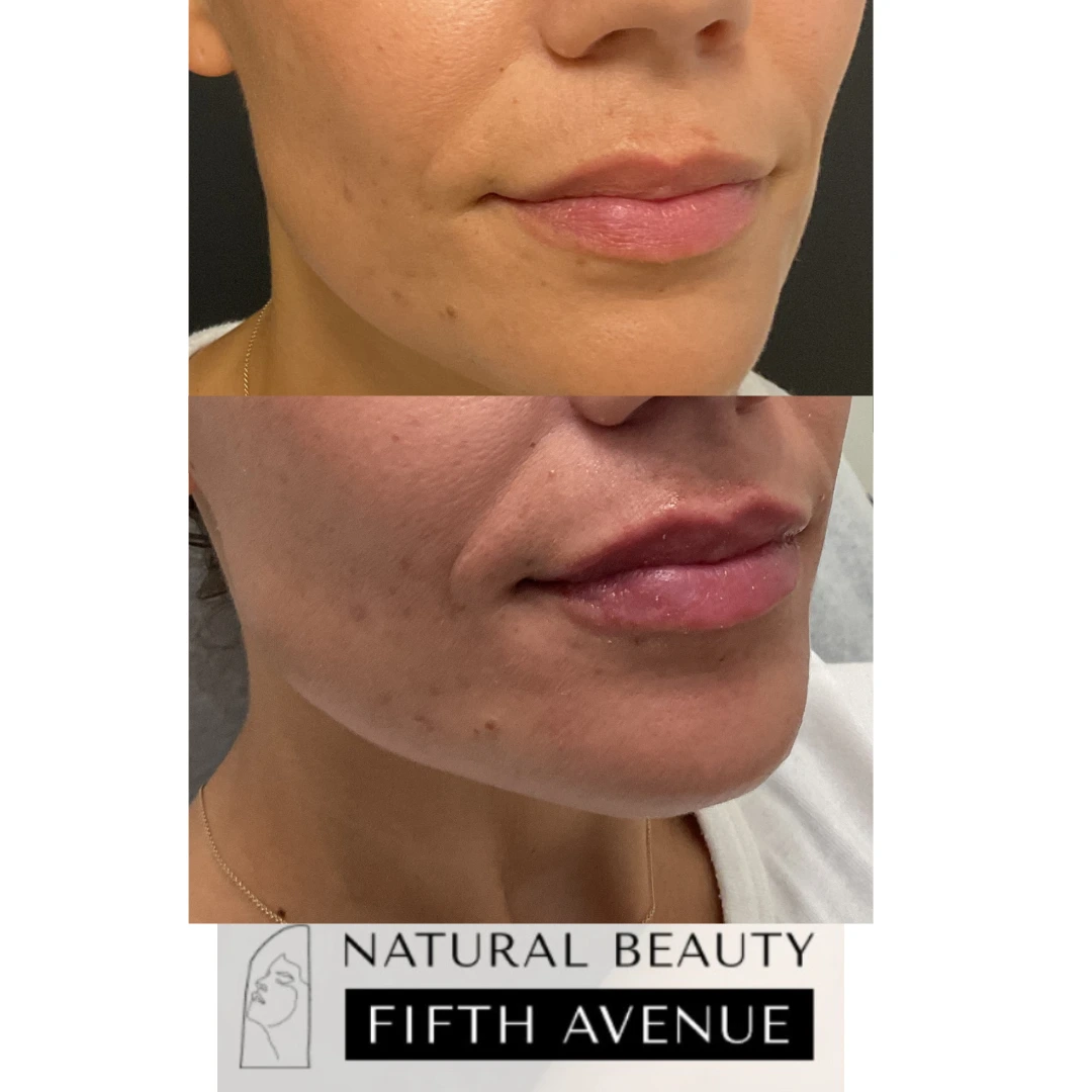 Before and after lip enhancement results showing fuller lips with improved definition